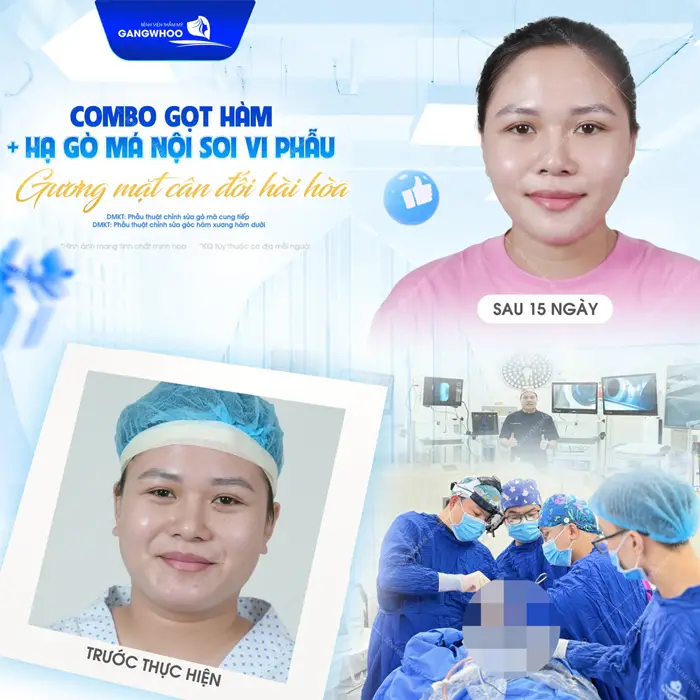 Combo gọt hàm và hạ gò má nội soi 4K gương mặt thêm cân đối, hài hòa với diện mạo thêm thon gọn