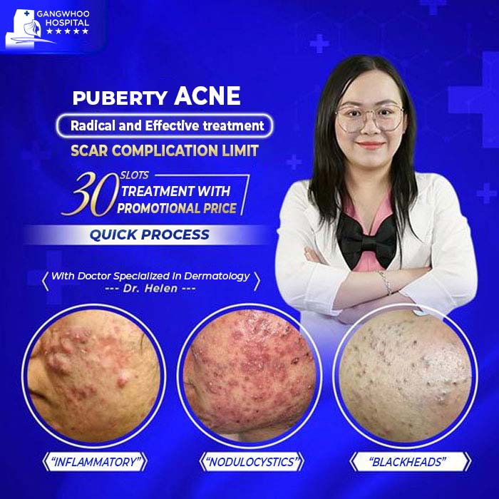 Acne Treatment Eliminate Stubborn Acne