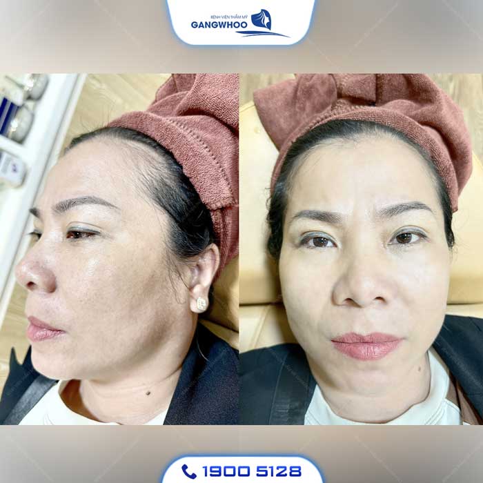 Điều Trị Nám Chuyên Sâu - Tạm Biệt Mảng Nám Cứng Đầu 15 dieu tri nam 1 1