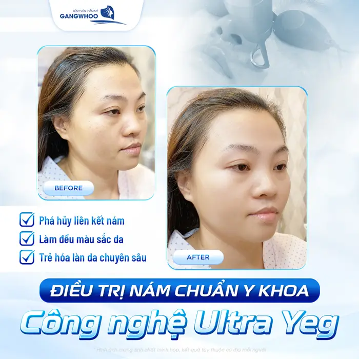 Điều Trị Nám Chuyên Sâu - Tạm Biệt Mảng Nám Cứng Đầu 7 Điều trị nám chuẩn y khoa công nghệ ULtra Yeg phá hủy nám hiệu quả da trẻ hóa chuyên sâu
