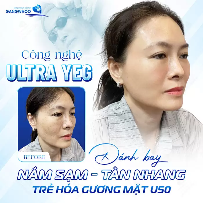 Điều Trị Nám Chuyên Sâu - Tạm Biệt Mảng Nám Cứng Đầu 1 Điều Trị Nám Chuyên Sâu - Tạm Biệt Mảng Nám Cứng Đầu