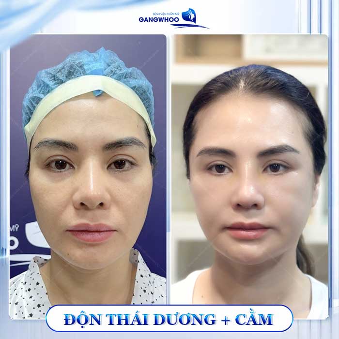 Độn Thái Dương Sở Hữu Gương Mặt Thanh Tú Đầy Sức Sống 10 Khuôn mặt thêm trẻ trung sau độn thái dương