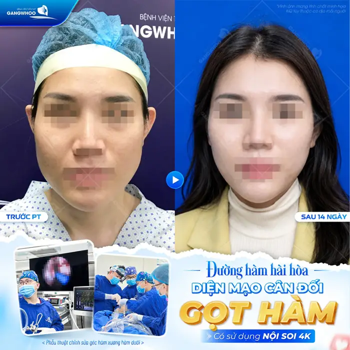 Đường hàm hài hòa diện mạo đẹp cân đối sau 14 ngày gọt hàm nhan sắc thay đổi đẹp đến bất ngờ