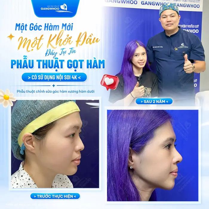 1 góc hàm mới 1 khởi đầu mới đầy tự tin sau phẫu thuật gọt hàm sử dụng hệ thống nội soi 4K