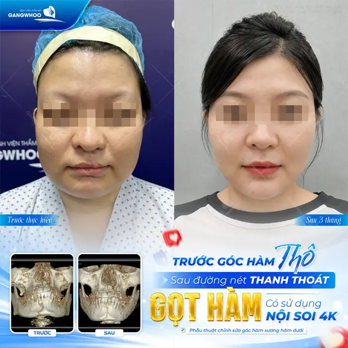 Những Điều Cần Biết Khi Phẫu Thuật Gọt Hàm - Định Phải Nhớ 2 Gọt hàm tạm biệt hàm thô đường nét thêm thành thoát và mềm mại