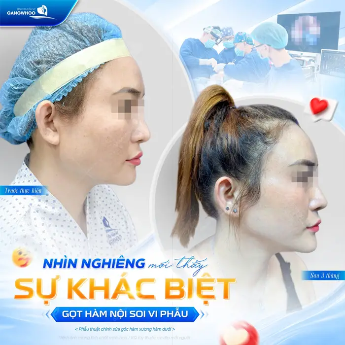 Gọt Hàm Hạ Gò Má Có Nguy Hiểm Không? Địa Chỉ Thẩm Mỹ An Toàn 3 Nghiêng mới thấy sự khá cbiệt sau gọt hàm nội soi vi phẫu tại bệnh viện thẩm mỹ Gangwhoo
