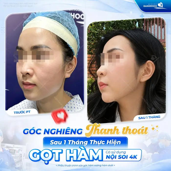 Góc nghiêng thanh thoát kết quả sau 1 tháng thực hiện gọt hàm đã hoàn toàn đã thay đổi