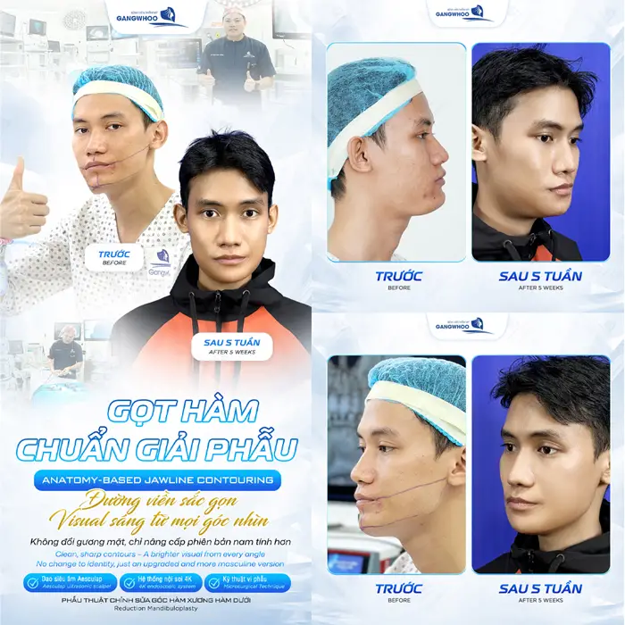 Gọt hàm chuẩn giải phẫu đường nét khuôn mặt thon gọn cân mọi góc nhìn 