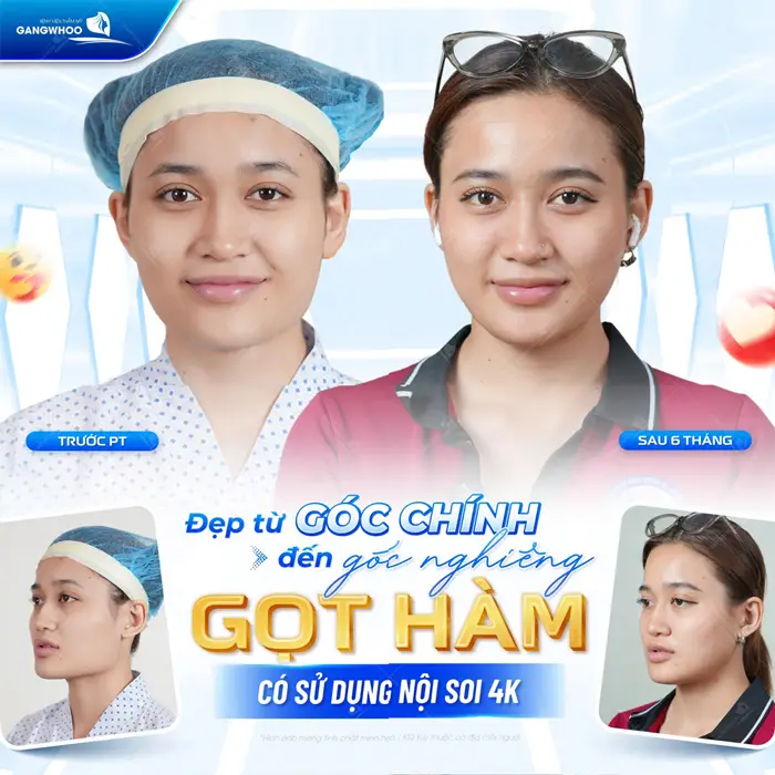 Những Điều Cần Biết Khi Phẫu Thuật Gọt Hàm - Định Phải Nhớ 4 Đẹp từ góc chính đến góc nghiêng sau gọt hàm sử dụng nội soi 4K