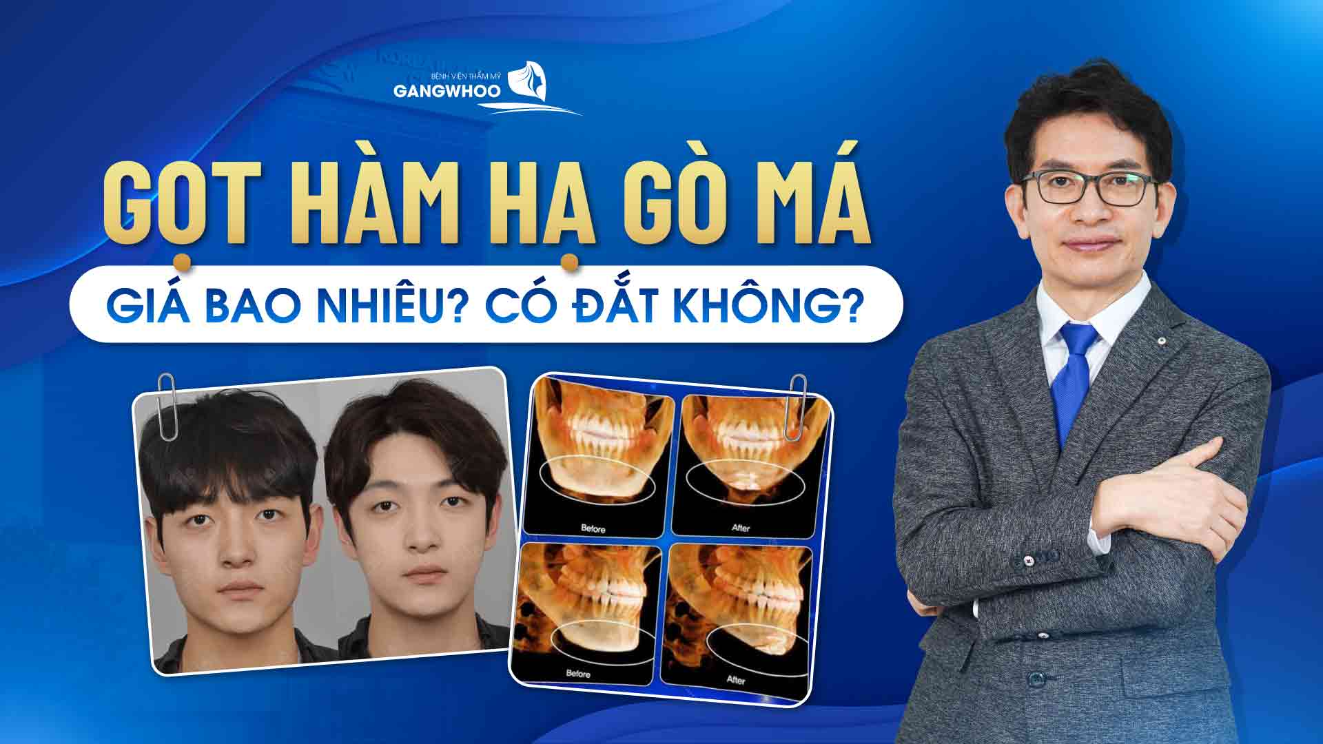 Gọt hàm hạ gò má giá bao nhiêu