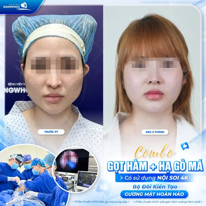 Thực hiện combo hạ gò má và gọt hàm có sử dụng nội soi 4K bộ đôi kiến tạo gương mặt hài hòa và thêm hoàn hảo