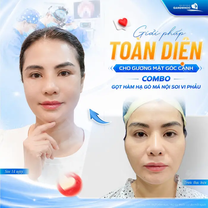 Tiết Lộ 8 Kinh Nghiệm Gọt Hàm: Hiệu Quả, An Toàn, Hạn Chế Rủi Ro 2 Giải pháp toàn diện cho gương mạt góc cạnh là combo gọt hàm hạ gò má tại bệnh viện thẩm mỹ Gangwhoo