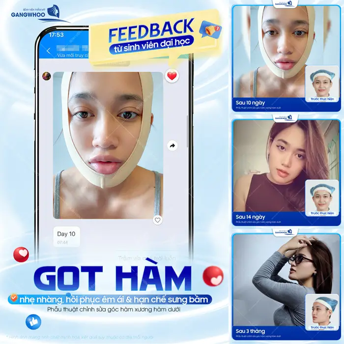 Gọt hàm nhẹ nhàng, hồi phục êm ái và hạn chế sưng bầm đẹp rõ rệt sau lên từng ngày