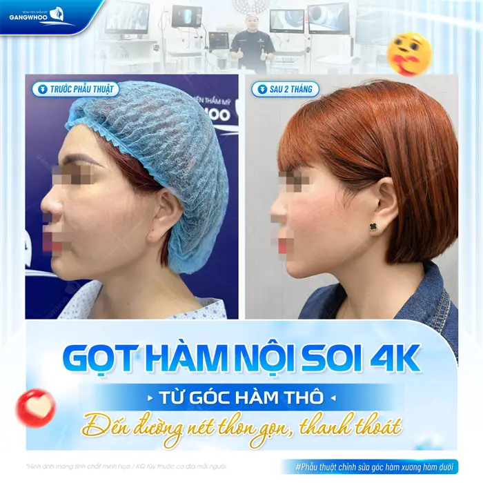 Gọt hàm nội soi 4K từ góc hàm thô đến đường nét thon gọn, thanh thoát