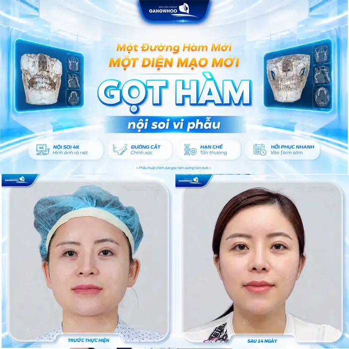 Gọt Hàm Có Để Lại Di Chứng Không? Cách Chăm Sóc Nhanh Lành 4 Gọt hàm nội soi vi phẫu 1 đường hàm mới 1 diện mạo mới sau 14 ngày gương mặt đã đẹp xuất sắc