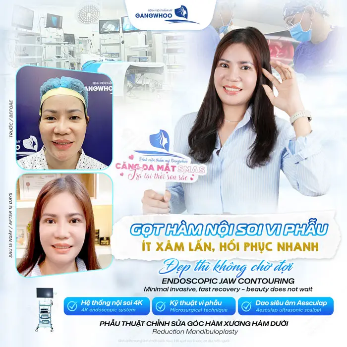 Phẫu thuật chỉnh sửa góc hàm xương hàm dưới an toàn, ít xâm lấn và nhanh hồi phục