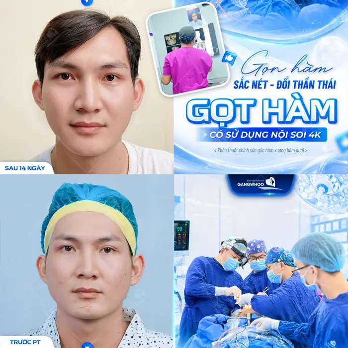 Gọt Hàm Bao Lâu Thì Hết Sưng? Cách Chăm Sóc Nhanh Hết Sưng 5 Gọt hàm sắc nét đổi thần thái sau gọt hàm có sử dụng nội soi 4K