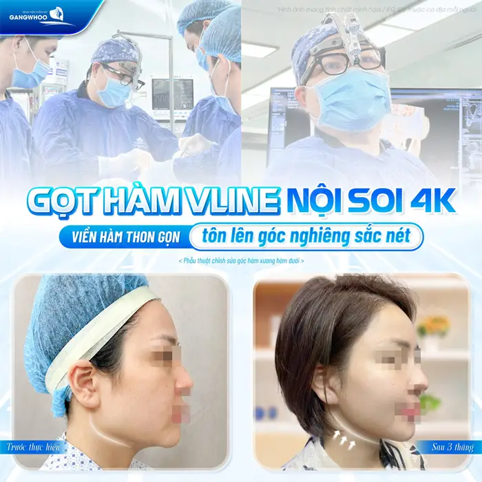 Gọt hàm V Line nội soi 4K viền hàm thon gọn tôn lên góc nghiêng sắc nét cho tổng thể diện mạo 