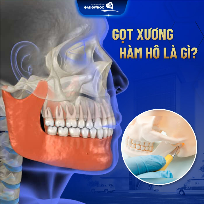 Gọt xương hàm hô