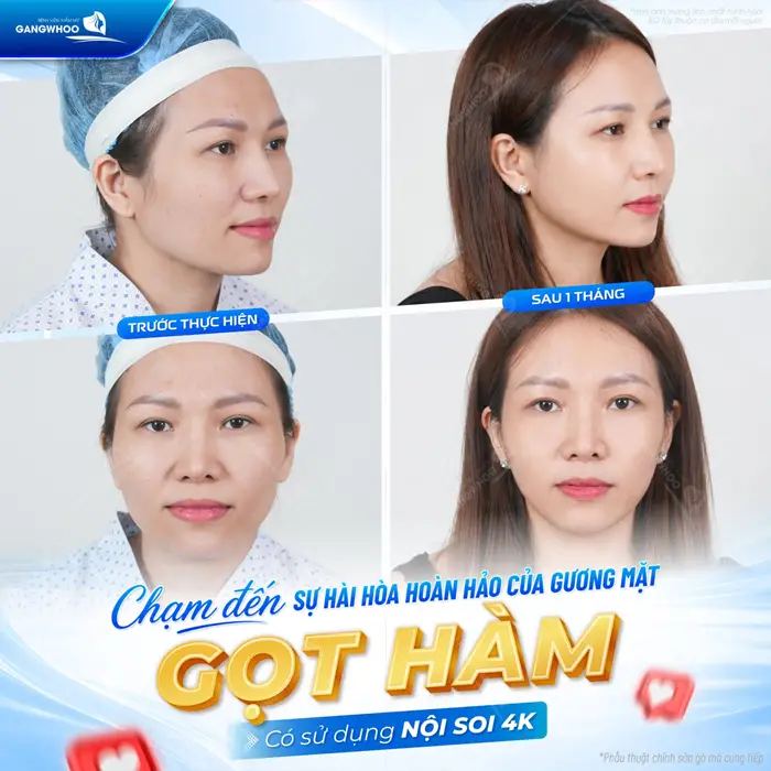 Gọt Hàm Bao Lâu Thì Hết Sưng? Cách Chăm Sóc Nhanh Hết Sưng 1 Chạm đến sự hài hòa hoàn hảo của gương mặt sau gọt hàm ứng dụng công nghệ nội soi 4K hiện đại