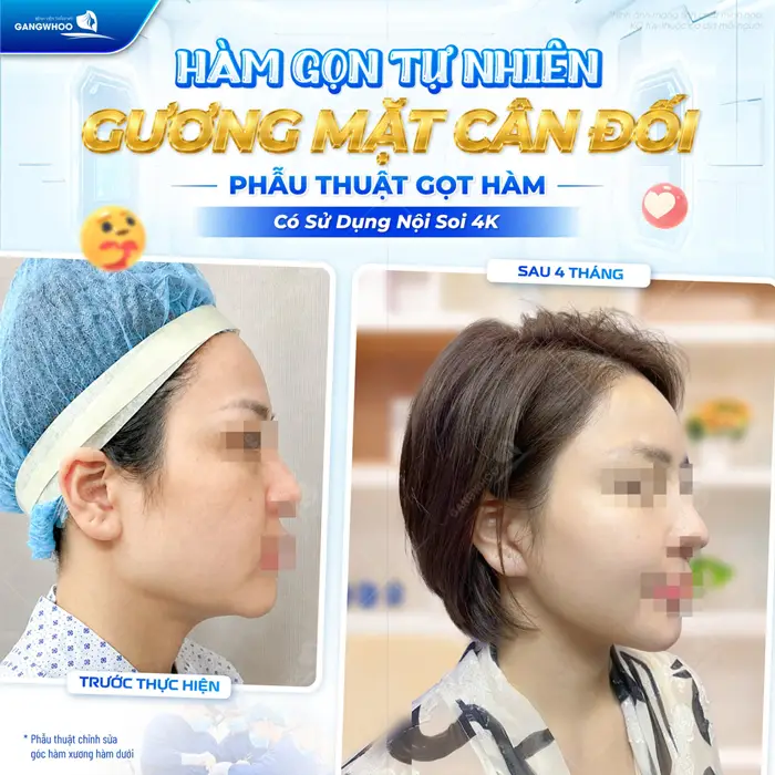 Hàm gọn tự nhiên gương mặt thêm cân đối sau phẫu thuật 4 tháng đường nét đẹp thon gọn và thanh thoát
