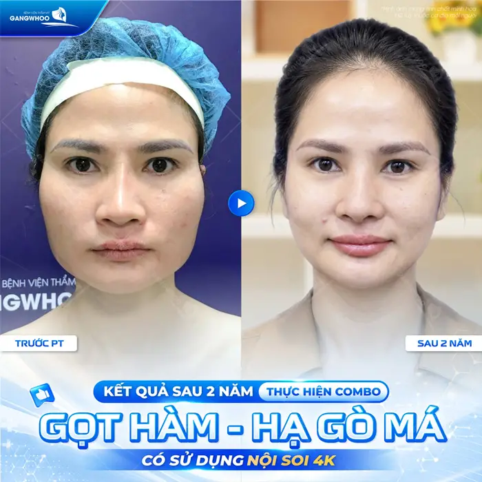 Kết quả sau 2 năm thực hiện combo gọt hàm và hạ gò má tại BVTM Gangwhoo