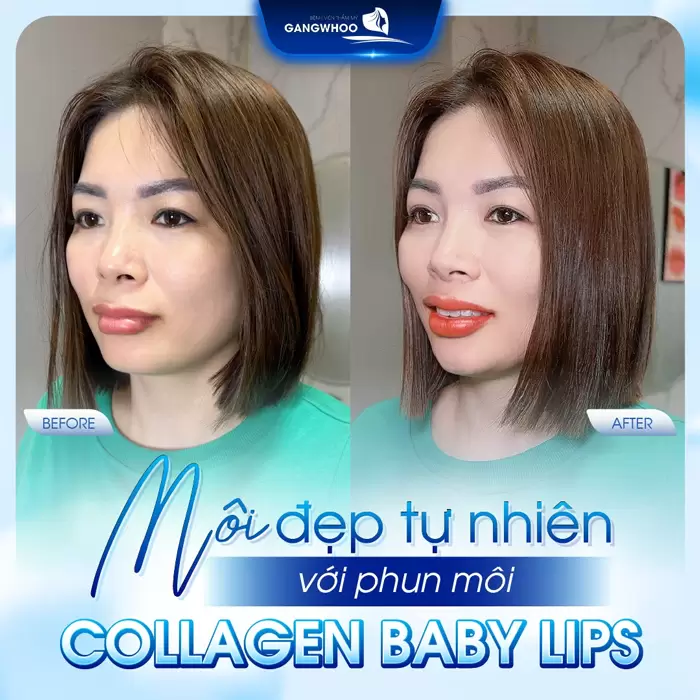 Phun Môi Là Gì? Khác Gì Xăm Môi? Top 9 Màu Hot 2025 1 moi dep tu nhien sau phun moi baby collagen