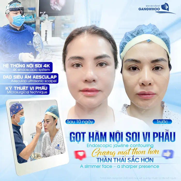 Gương mặt thon gọn, mềm mại dài lâu kết quả thay đổi rõ rệt sau 10 ngày thực hiện 