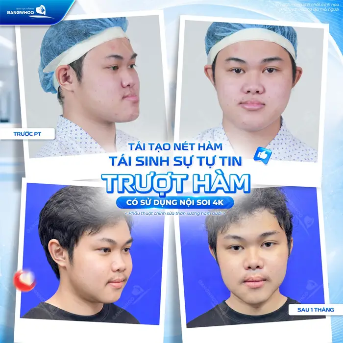Trượt hàm tái tạo nét hàm đẹp đúng tỷ lệ gương mặt thêm tự tin và cân đối