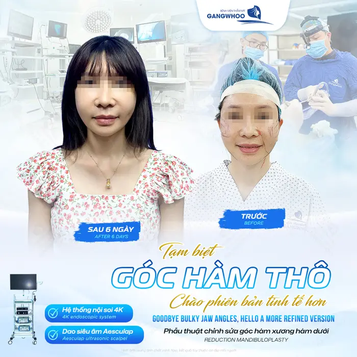 Phẫu thuật chỉnh sửa góc hàm xương hàm dưới tạm biệt góc hàm thô chào đón gương mặt đẹp thanh thoát
