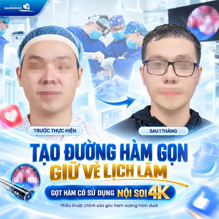 Tạo đường hàm gọn giữu vẻ đẹp lịch lãm với công nghệ gọt hàm có sử dụng nội soi 4K