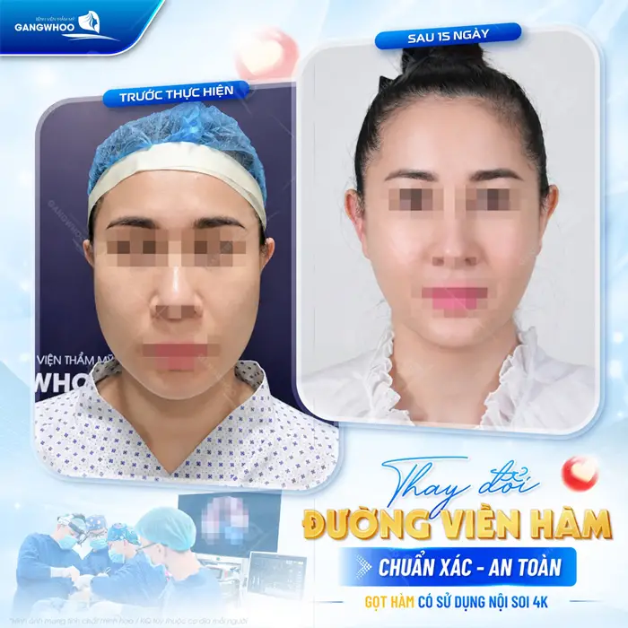 Tiết Lộ 8 Kinh Nghiệm Gọt Hàm: Hiệu Quả, An Toàn, Hạn Chế Rủi Ro 1 Thay đổi đường viền hàm chuẩn xác, an toàn với công nghệ nội soi 4K mặt thon, đẹp gọn sau 15 ngày đã hoàn toàn thăng hạng