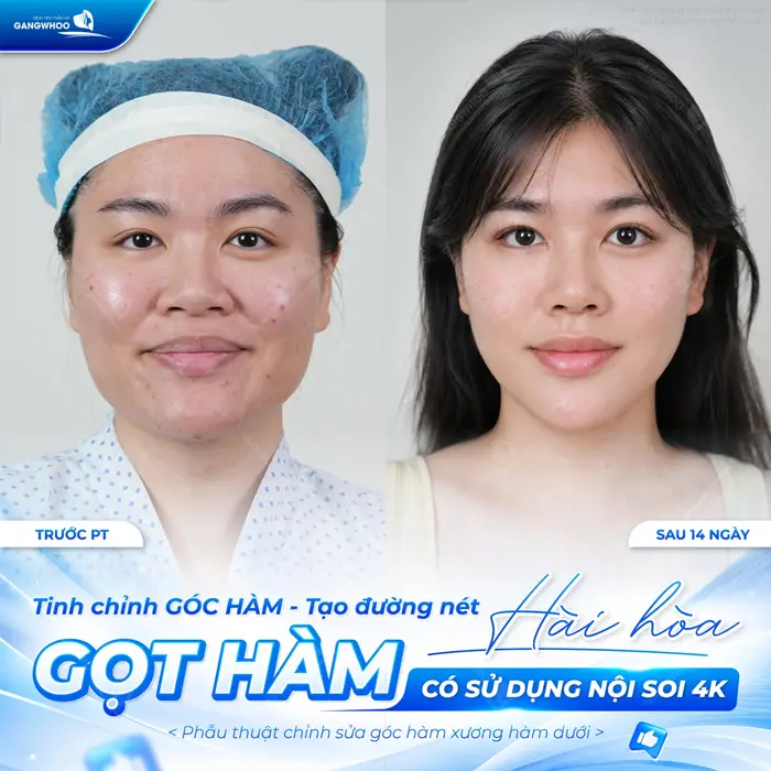 Tinh chỉnh góc hàm kiến tạo đường viền hàm hài hòa, cân đối sau 14 ngày gương mặt thon gọn và hài hòa hơn thấy rõ