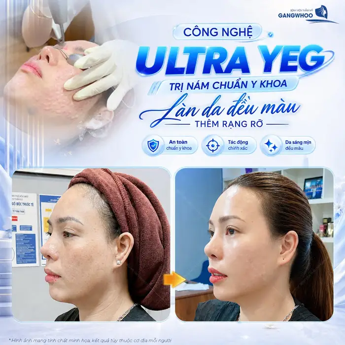 Trị nám chuẩn y khoa làn da đều màu gương mặt thêm rạng rỡ ngày càng đẹp và rạng rỡ hơn