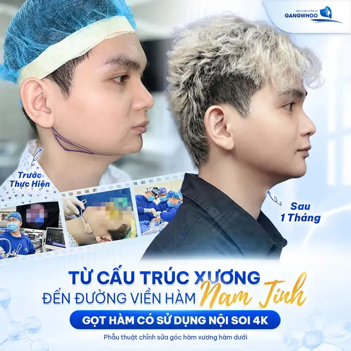 Tiết Lộ 8 Kinh Nghiệm Gọt Hàm: Hiệu Quả, An Toàn, Hạn Chế Rủi Ro 4 Từ cấu trúc xương đến viềm hàm chuẩn nam tính sau gọt hàm có sử dụng công nghệ nội soi 4K
