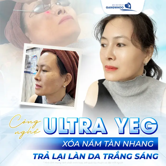 Điều Trị Nám Chuyên Sâu - Tạm Biệt Mảng Nám Cứng Đầu 3 Công nghệ Ultra Yeg xóa nám tàn nhang trả lại làn da trắng sáng hiệu quả sau 1 liệu trình thực hiện