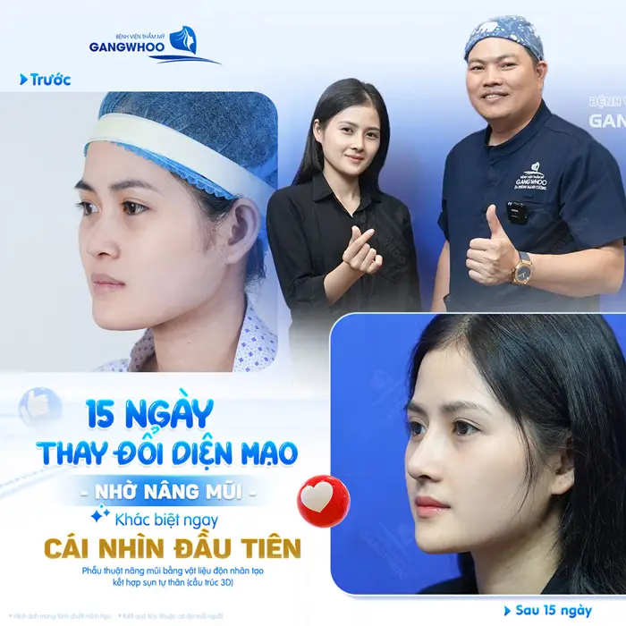 Phẫu Thuật Nâng Mũi Bằng Vật Liệu Độn Nhân Tạo Kết Hợp Sụn Tự Thân (Nâng Mũi Zose Line) 1 Dáng mũi 15 ngày tuổi thay đổi diện mạo đẹp xuất sắc khiến ai gặp cũng phải ngỡ ngàng vì quá xinh đẹp