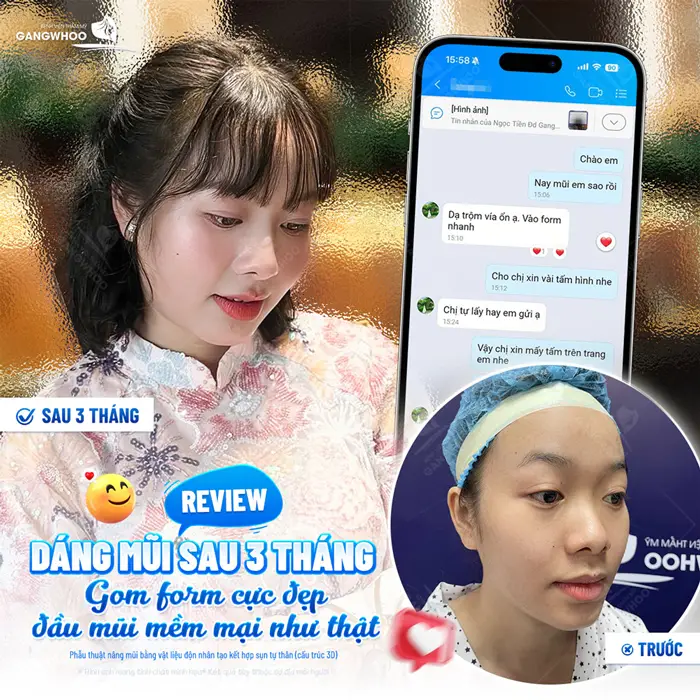 Phẫu Thuật Nâng Mũi Bằng Vật Liệu Độn Nhân Tạo Kết Hợp Sụn Tự Thân (Nâng Mũi Zose Line) 25 dang mui sau 1 thang vao form cuc dep khach hang hai long ve dien mao moi