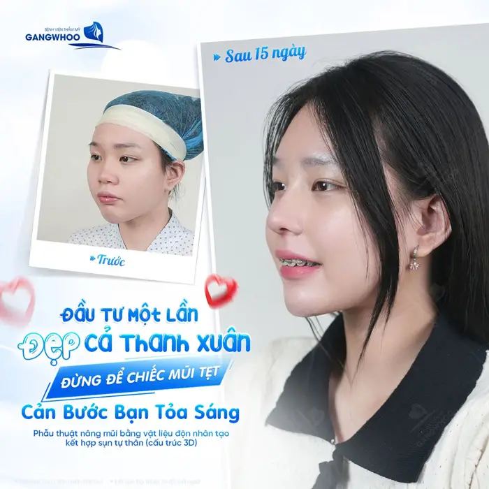 Phẫu Thuật Nâng Mũi Bằng Vật Liệu Độn Nhân Tạo Kết Hợp Sụn Tự Thân (Nâng Mũi Zose Line) 9 Nhan sắc thăng hạng diện mạo thêm tươi xinh sau 15 ngày nâng mũi đã hóa phiên bản rạng rỡ