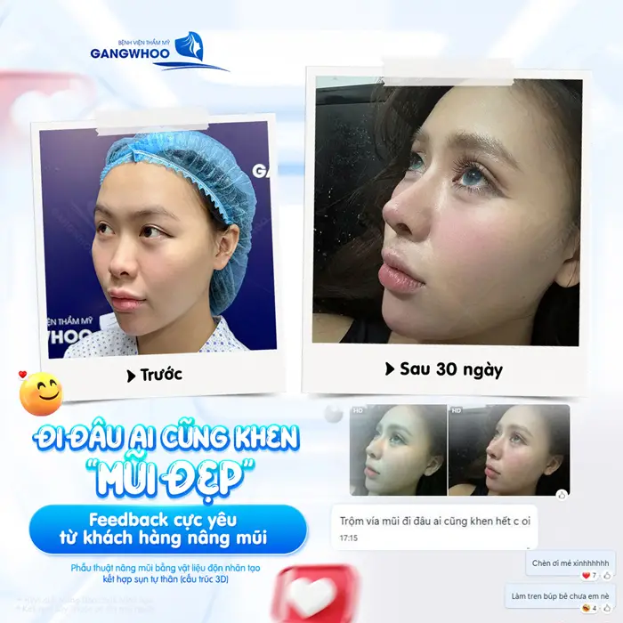 Phẫu Thuật Nâng Mũi Bằng Vật Liệu Độn Nhân Tạo Kết Hợp Sụn Tự Thân (Nâng Mũi Zose Line) 27 di dau ai cung khen mui dep feedback cuc dang yeu den tu ban khach hang xinh dep