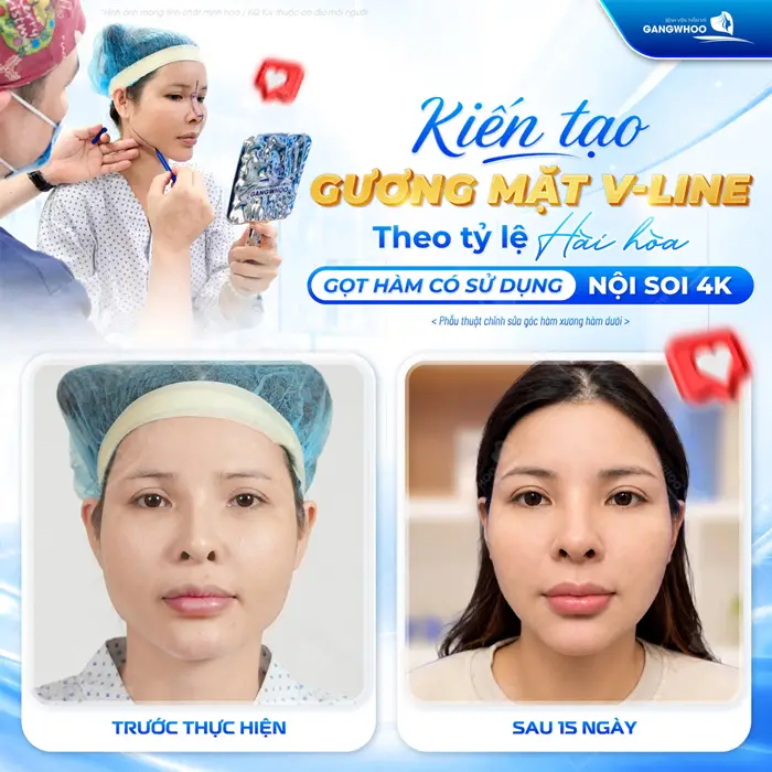 Kiến tạo gương mặt V Lien đẹp chuẩn tỷ lệ hài hòa gọt hàm ứng dụng công nghệ nội soi 4K 