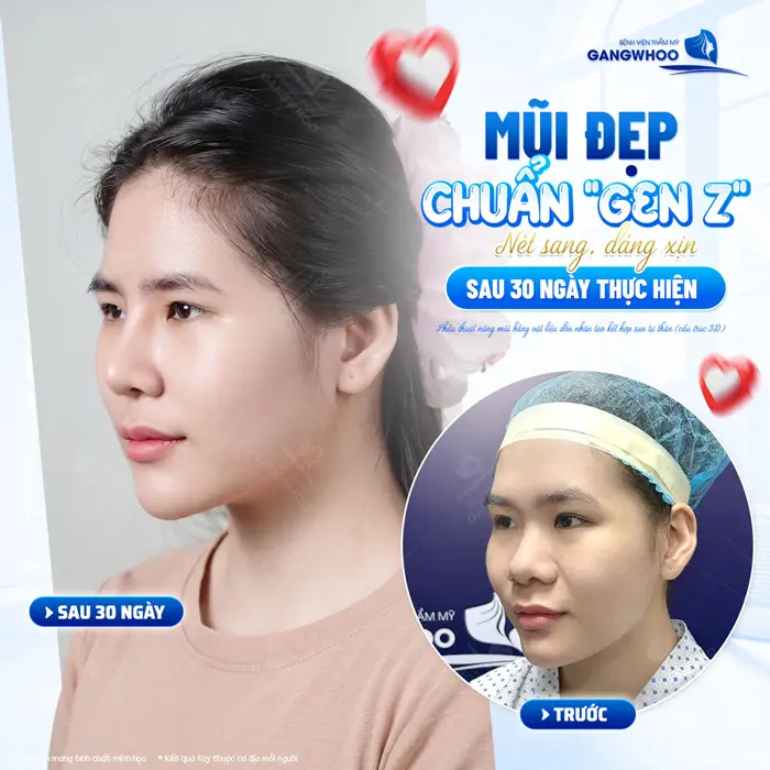Phẫu Thuật Nâng Mũi Bằng Vật Liệu Độn Nhân Tạo Kết Hợp Sụn Tự Thân (Nâng Mũi Zose Line) 11 Mũi đẹp chuẩn GenZ nét sang, dáng xịn sau 30 ngày thực hiện đường nét gương mặt đã thêm hài hòa và cuốn hút