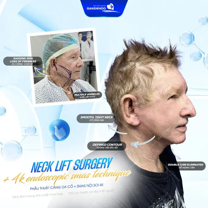 Phẫu thuật căng da cổ Smas nội soi 4K vùng da cổ phẳng mịn, căng lì an toàn và không xâm lấn