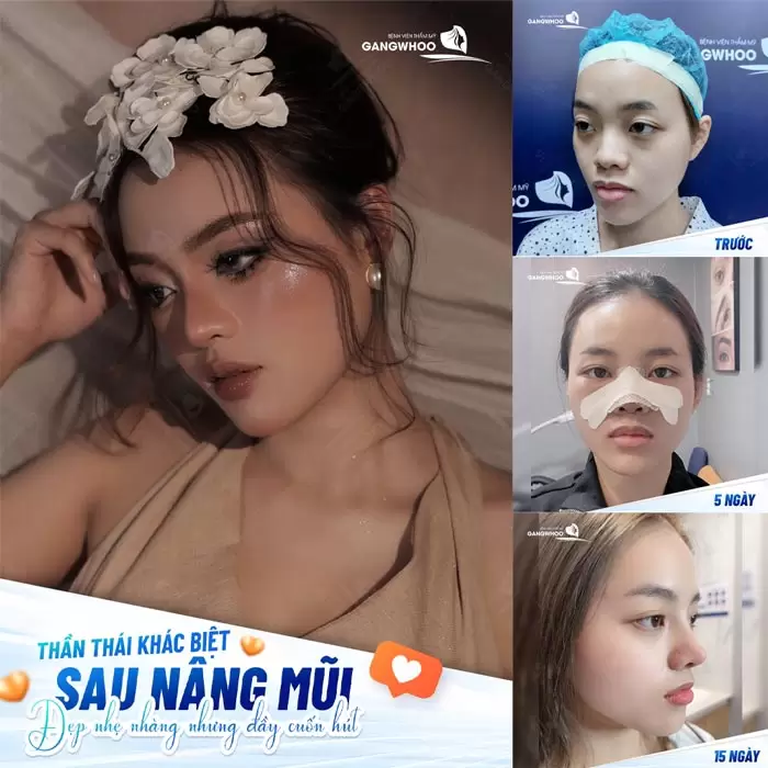 Nâng Mũi Zose Line - GenZ Nâng Là Đẹp 1 Nâng Mũi Zose Line - GenZ Nâng Là Đẹp