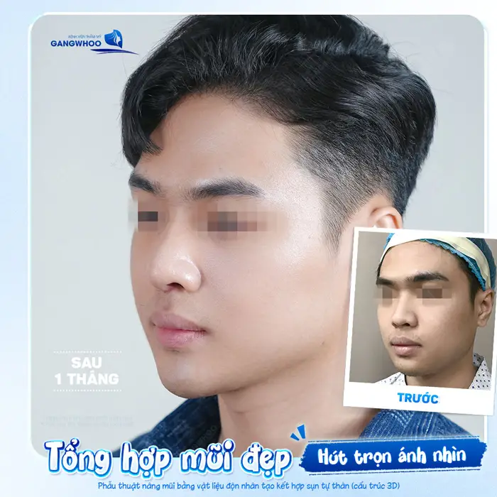 Mũi đẹp hút trọn ánh nhìn tự tin khoe góc nghiêng đẹp chuẩn sau 1 tháng can thiệp phẫu thuật 