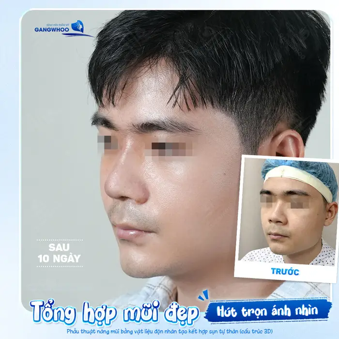 tong hop dang mui dep tai bvtm gangwhoo1