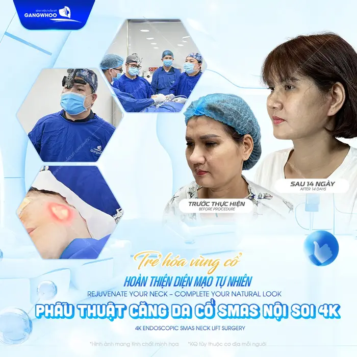 Trẻ hóa vùng cồ hoàn thiện diện mạo sau 14 ngày phẫu thuật căng da cổ Smas nội soi kết quả đã hoàn toàn khác biệt