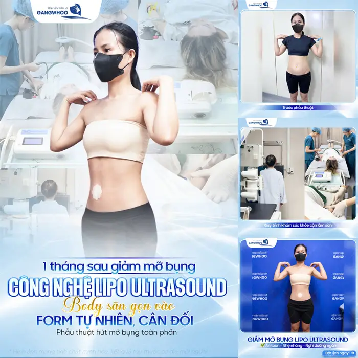 Hút Mỡ Bụng Có An Toàn Không? 5 Điều Cần Lưu Ý Khi Hút Mỡ 9 1 tháng sau giảm mỡ bụng công nghệ Lipo Ultrasound body săn gọn và vào form đẹp tự nhiên, cân đối