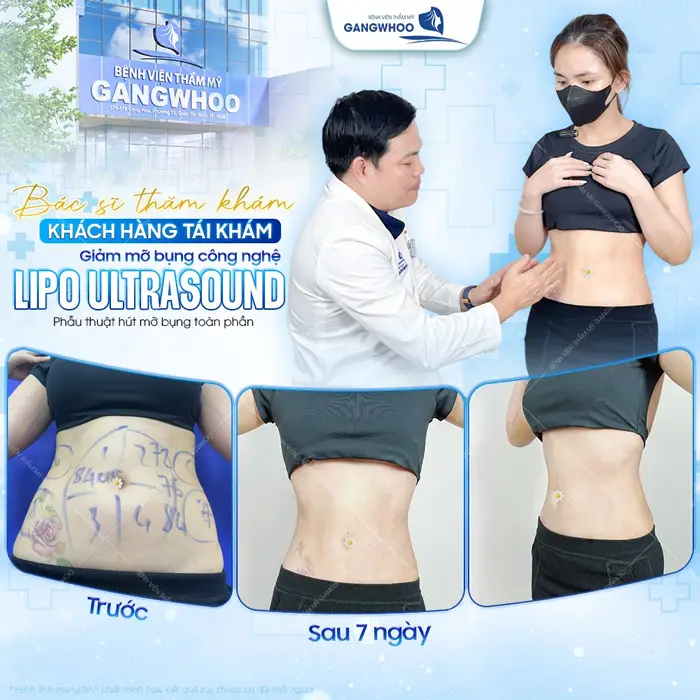 Bác sĩ thăm khám tái khám sau giảm mỡ bụng công nghệ Lipo Ultrasound sau 7 ngày vòng 1 đã đẹp xuất sắc