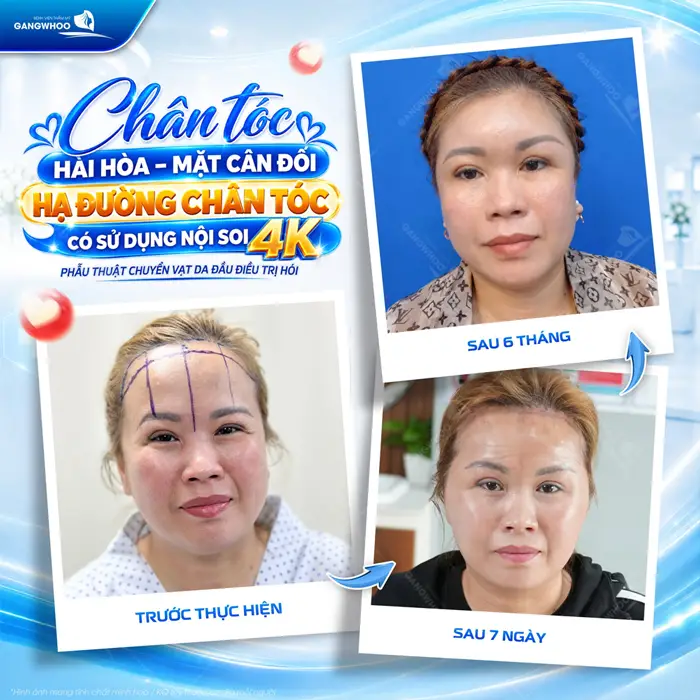 Hạ đường chân tóc gương mặt hài hòa, đường nét cân đối kết quả sau 6 tháng diện mạo hài hòa và thêm xuất sắc 